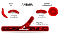 What is Sickle Cell Anemia photocredit: https://www.thebridgeclinic.com/